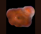 Part 1 Episode 1 Expert Insights Into Surgical Fundamentals Rhegmatogenous Retinal Detachment
