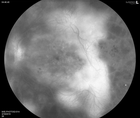 Socioeconomics and Retinal Care Reaching Those At Risk