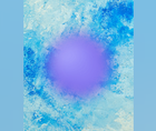 Synechialysis and Corneal Inlays