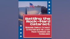 Battling the RockHard Cataract Managing Complex Cataract Extraction with the Latest Phaco Techniques and Technologies