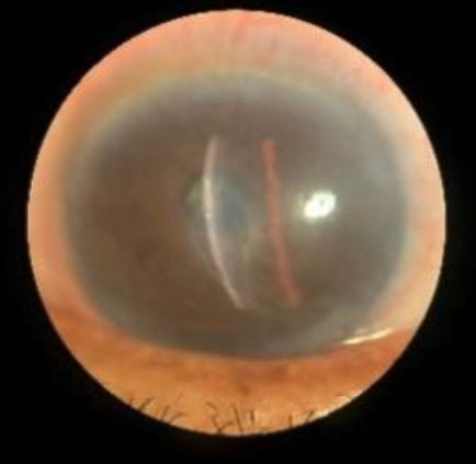 Patient Care Update Neurotrophic Keratitis Diagnosis Treatment and Referrals