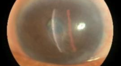 Patient Care Update Neurotrophic Keratitis Diagnosis Treatment and Referrals