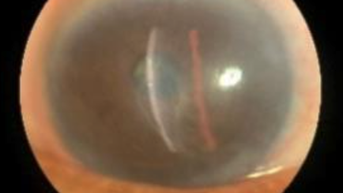 Patient Care Update Neurotrophic Keratitis Diagnosis Treatment and Referrals