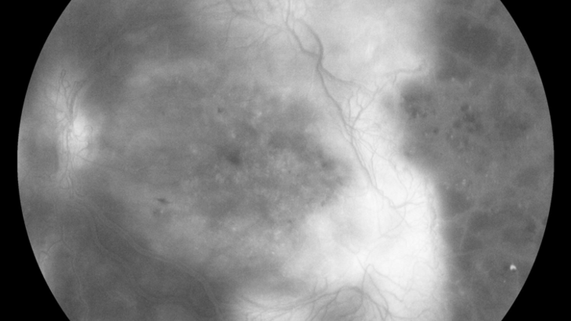 Socioeconomics and Retinal Care Reaching Those At Risk