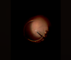 Part 1 Episode 2 Expert Insights Into Surgical Fundamentals Macular Hole Pearls
