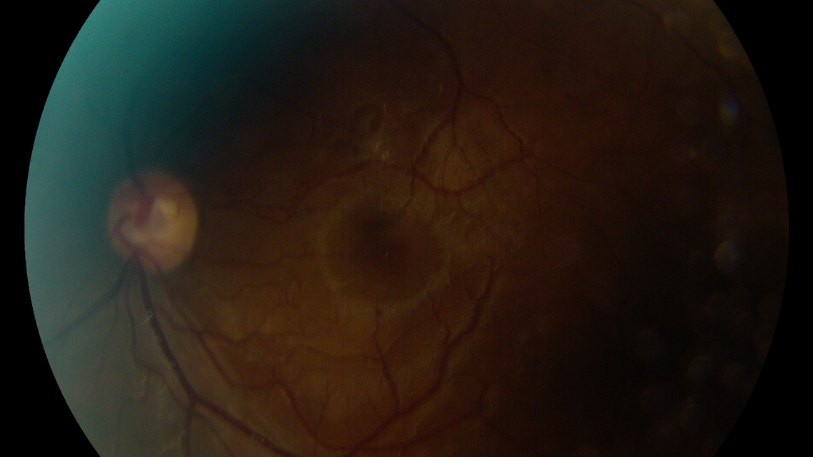 Challenging Diabetic Cases A Discussion on the Art and Science of Patient Management