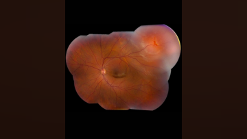 Part 1 Episode 1 Expert Insights Into Surgical Fundamentals Rhegmatogenous Retinal Detachment