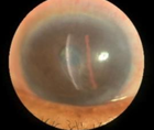 Patient Care Update Neurotrophic Keratitis Diagnosis Treatment and Referrals