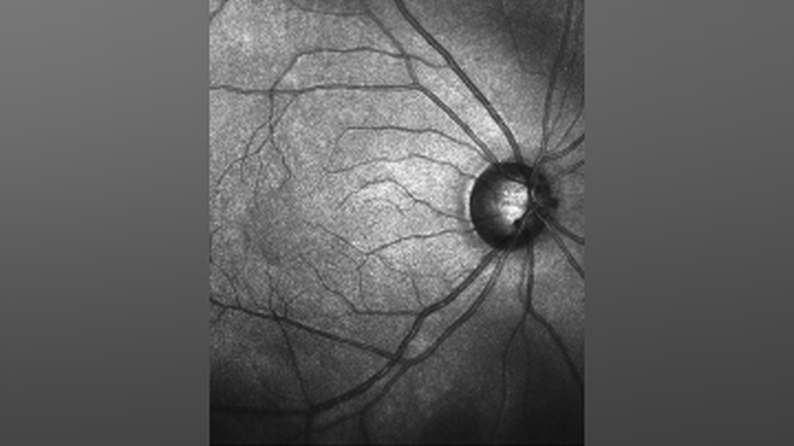 GA Perspectives An InDepth Look at the Potential of Pipeline Therapies