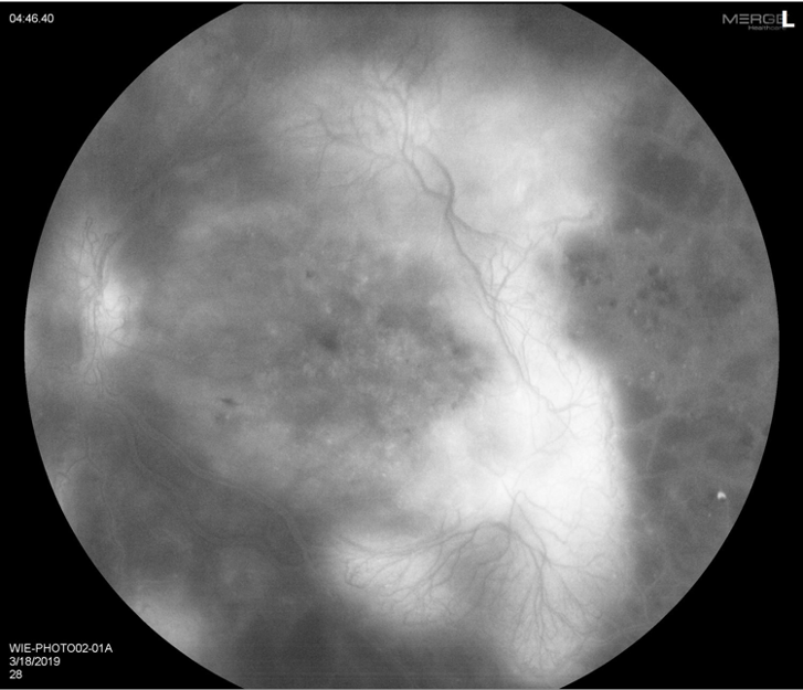 Socioeconomics and Retinal Care Reaching Those At Risk