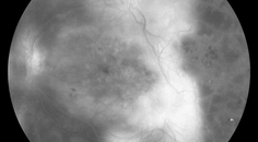 Socioeconomics and Retinal Care Reaching Those At Risk