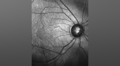 GA Perspectives An InDepth Look at the Potential of Pipeline Therapies